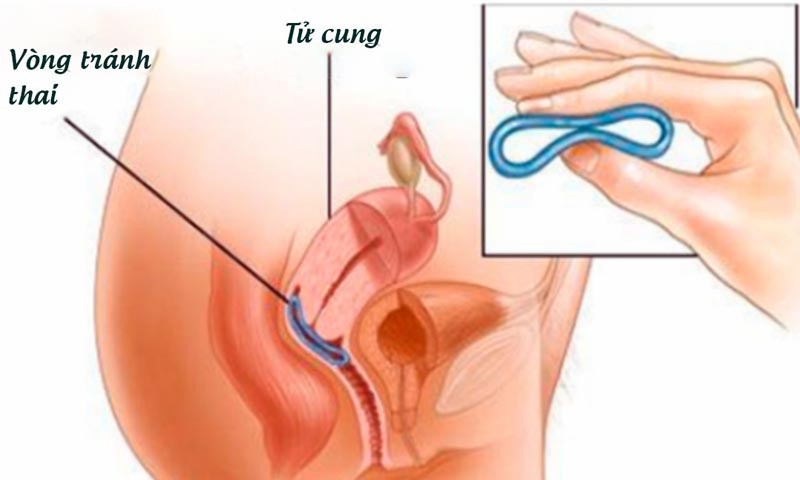 Vòng tránh thai có thể gây thủng đại tràng, bàng quang, ruột